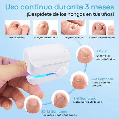 Muestra tus Pies Sin Esconder nada - Láser para Hongos en las Uñas